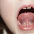 Short frenulum of the tongue (scalpel or laser?