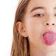 Crvene mrlje u odraslih na jeziku sa ili bez bijele prevlake: alergije i drugi uzroci naslaga s fotografijom